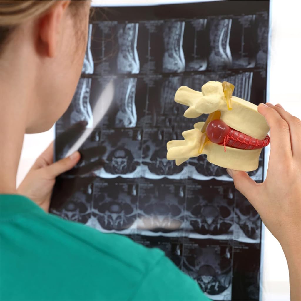 HASTHIP Human Anatomical Lumbar Disc Herniation Model, 1.5 Times Life Size Lumbar Disc Herniation Model, Human Lumbar Disc Herniation Model for Teaching, Learning, Demonstrating (Yellow)