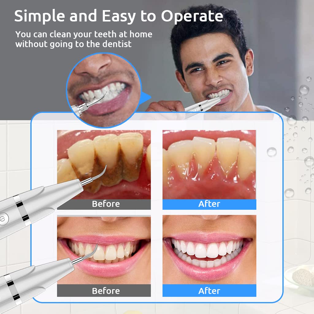 HANNEA Plaque Remover for Teeth, Teeth Cleaner Dental Calculus Remover Teeth Cleaning Kit with Led, Adjustable 5 Modes, Replaceable Clean Heads Safe for Adult Kids