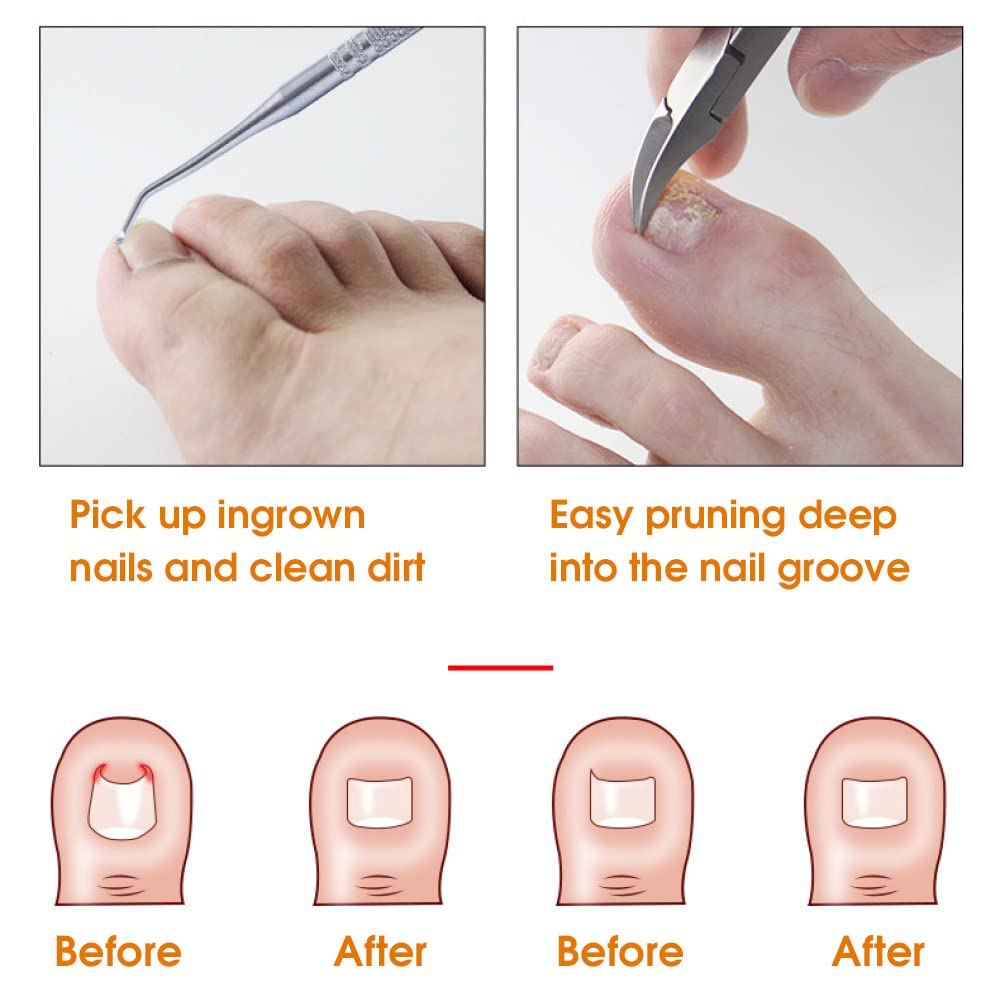 MAYCREATE Ingrown Toenail Clippers for Ingrown or Thick Toenails,Wide Jaw Opening Nail Clippers with Curved and Slant Straight Blade Edge, 6 PCS Stainless Steel Toe Nail Clipper for Men