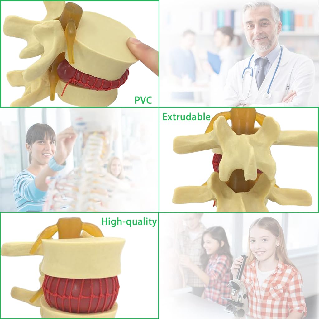 HASTHIP Human Anatomical Lumbar Disc Herniation Model, 1.5 Times Life Size Lumbar Disc Herniation Model, Human Lumbar Disc Herniation Model for Teaching, Learning, Demonstrating (Yellow)