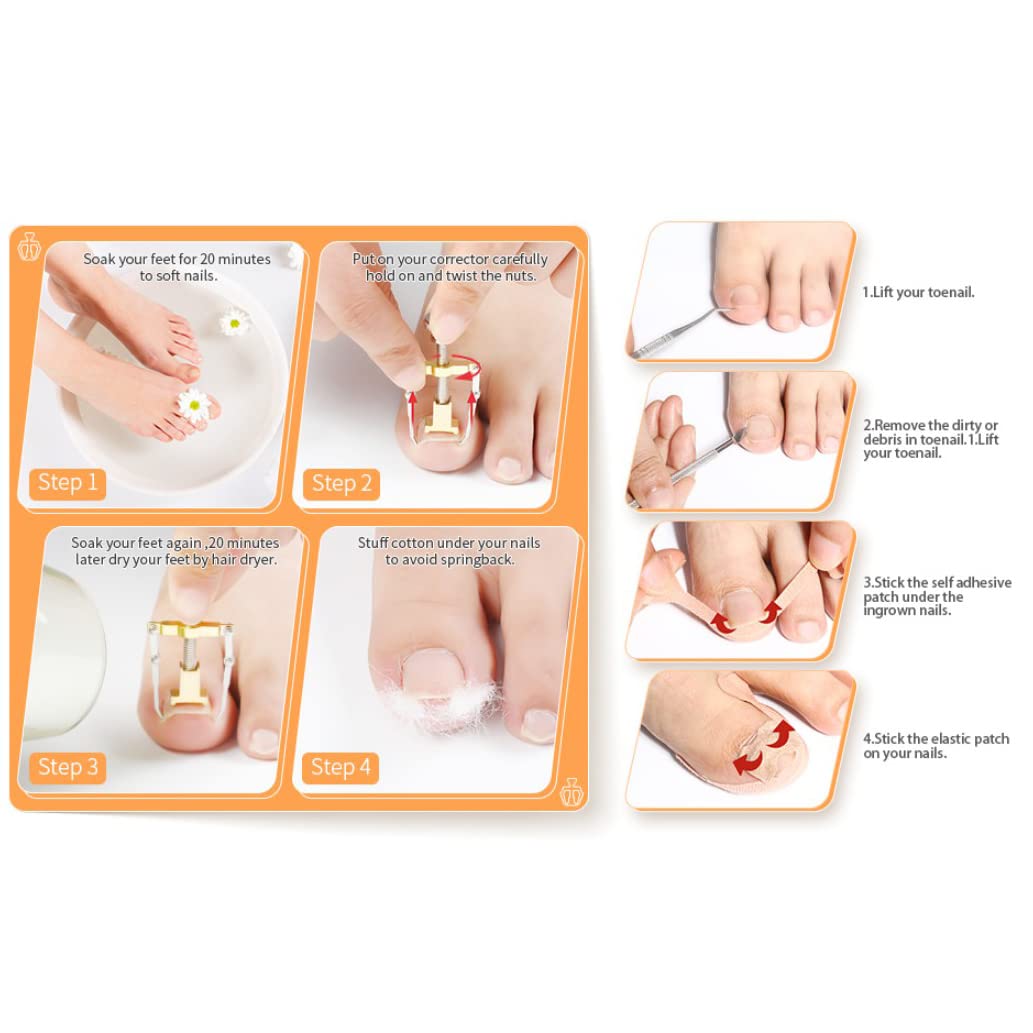 MAYCREATE Ingrown Toenail Treatment Tool Kit 8 Pieces Ingrown Toenail Corrector Kit Includes Ingrown Toenail Lifter, Ingrown Toenail Cuticle Tool, 16 Toenails Brace Stickers, Toenail File