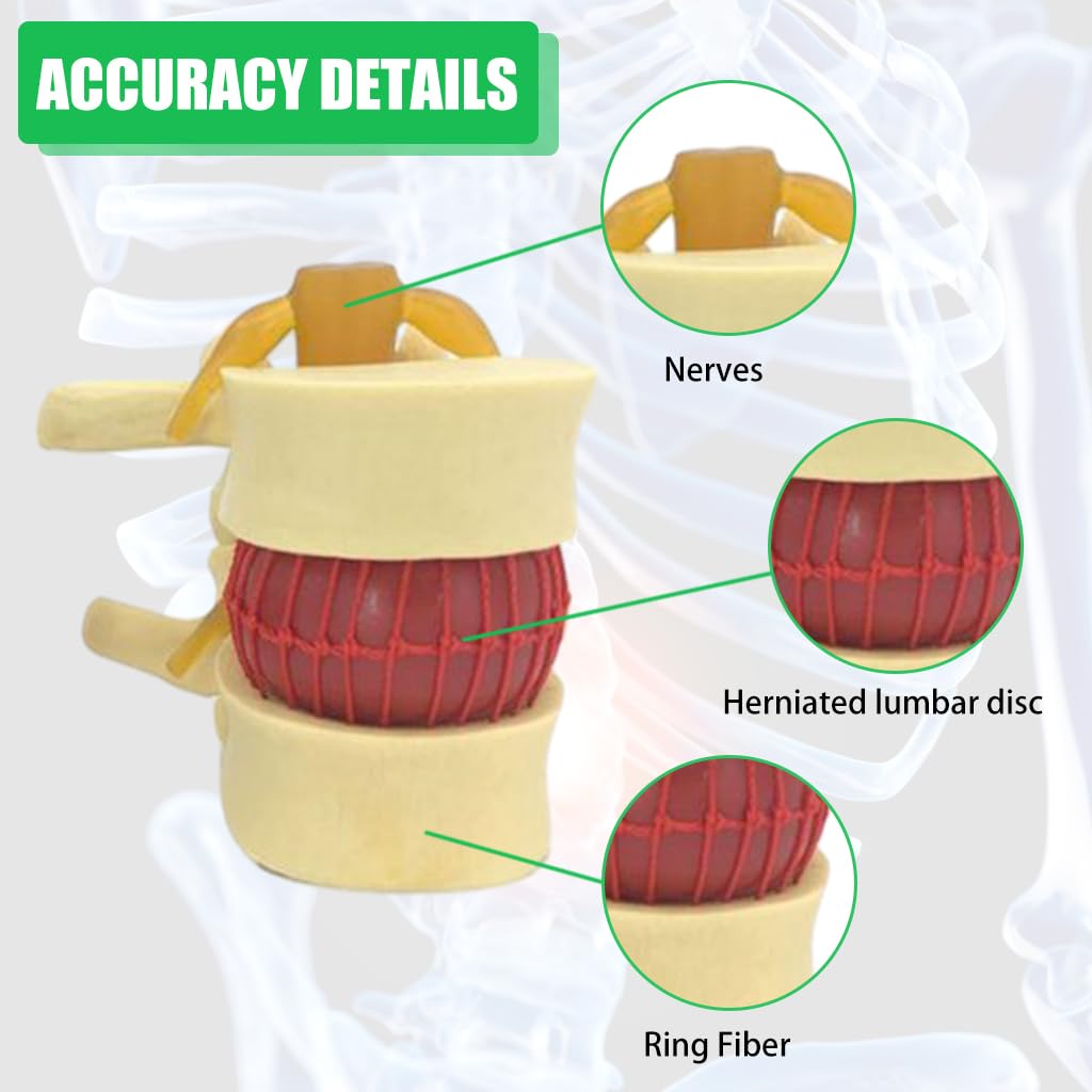 HASTHIP Human Anatomical Lumbar Disc Herniation Model, 1.5 Times Life Size Lumbar Disc Herniation Model, Human Lumbar Disc Herniation Model for Teaching, Learning, Demonstrating (Yellow)
