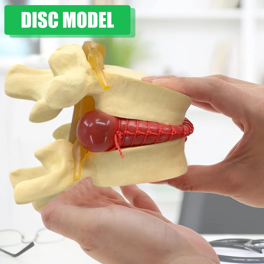 HASTHIP® Human Anatomical Lumbar Disc Herniation Model, 1.5 Times Life Size Lumbar Disc Herniation Model, Human Lumbar Disc Herniation Model for Teaching, Learning, Demonstrating (Yellow)