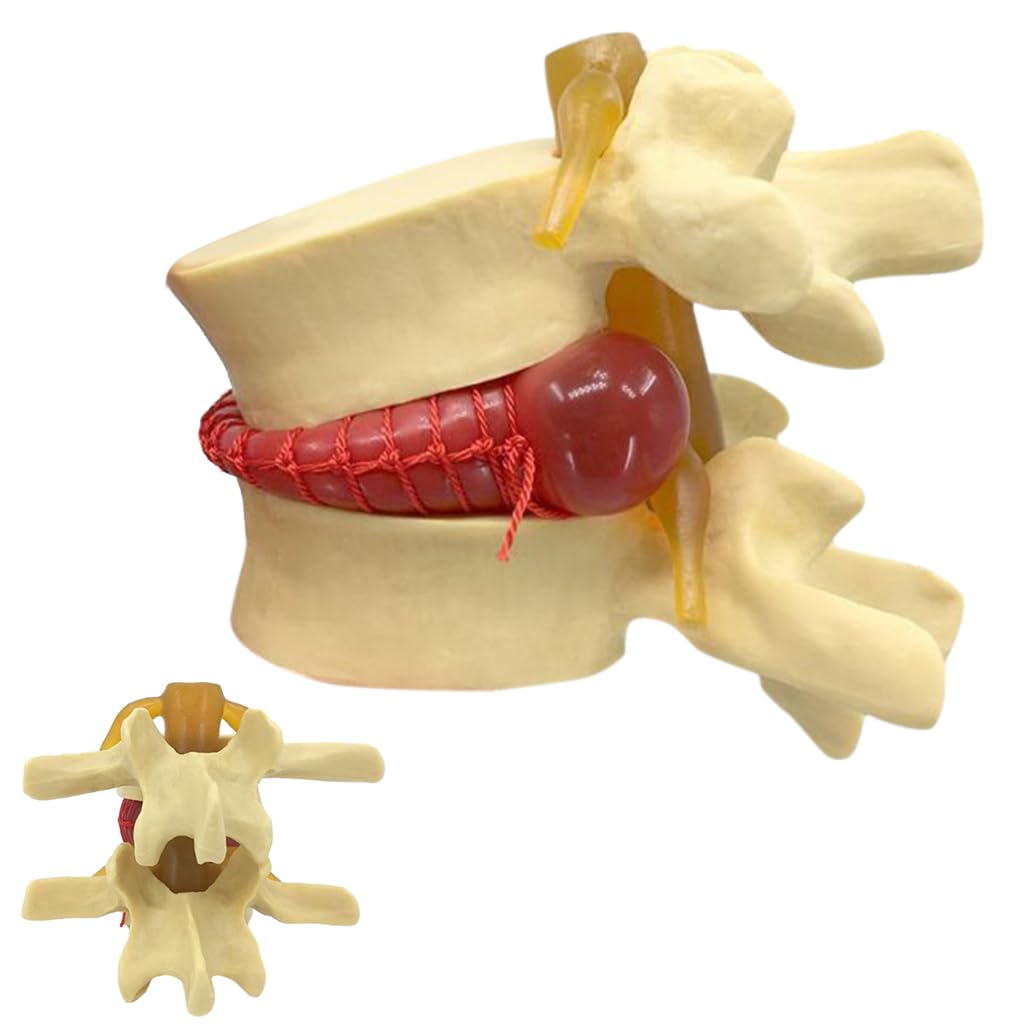 HASTHIP® Human Anatomical Lumbar Disc Herniation Model, 1.5 Times Life Size Lumbar Disc Herniation Model, Human Lumbar Disc Herniation Model for Teaching, Learning, Demonstrating (Yellow)