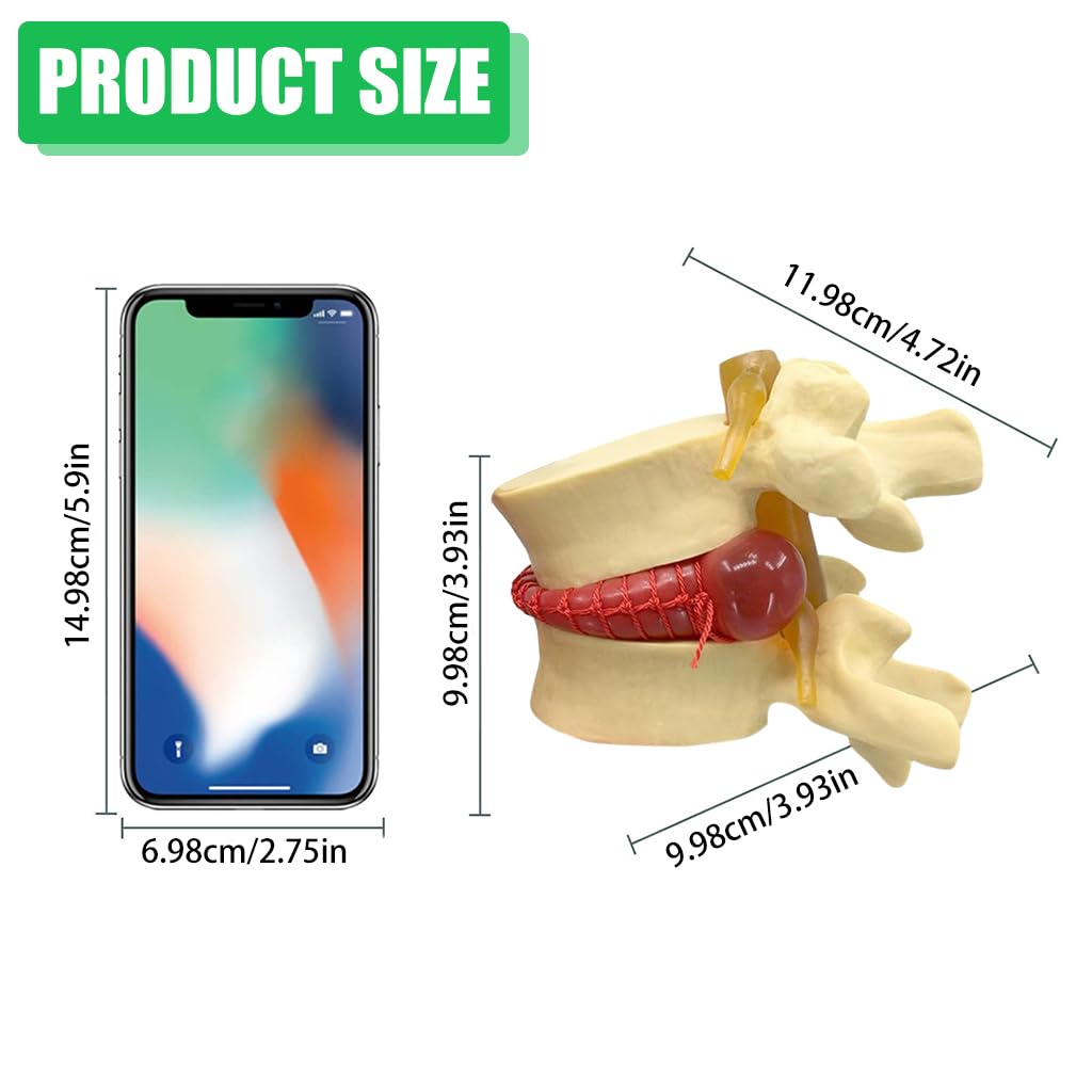 HASTHIP® Human Anatomical Lumbar Disc Herniation Model, 1.5 Times Life Size Lumbar Disc Herniation Model, Human Lumbar Disc Herniation Model for Teaching, Learning, Demonstrating (Yellow)