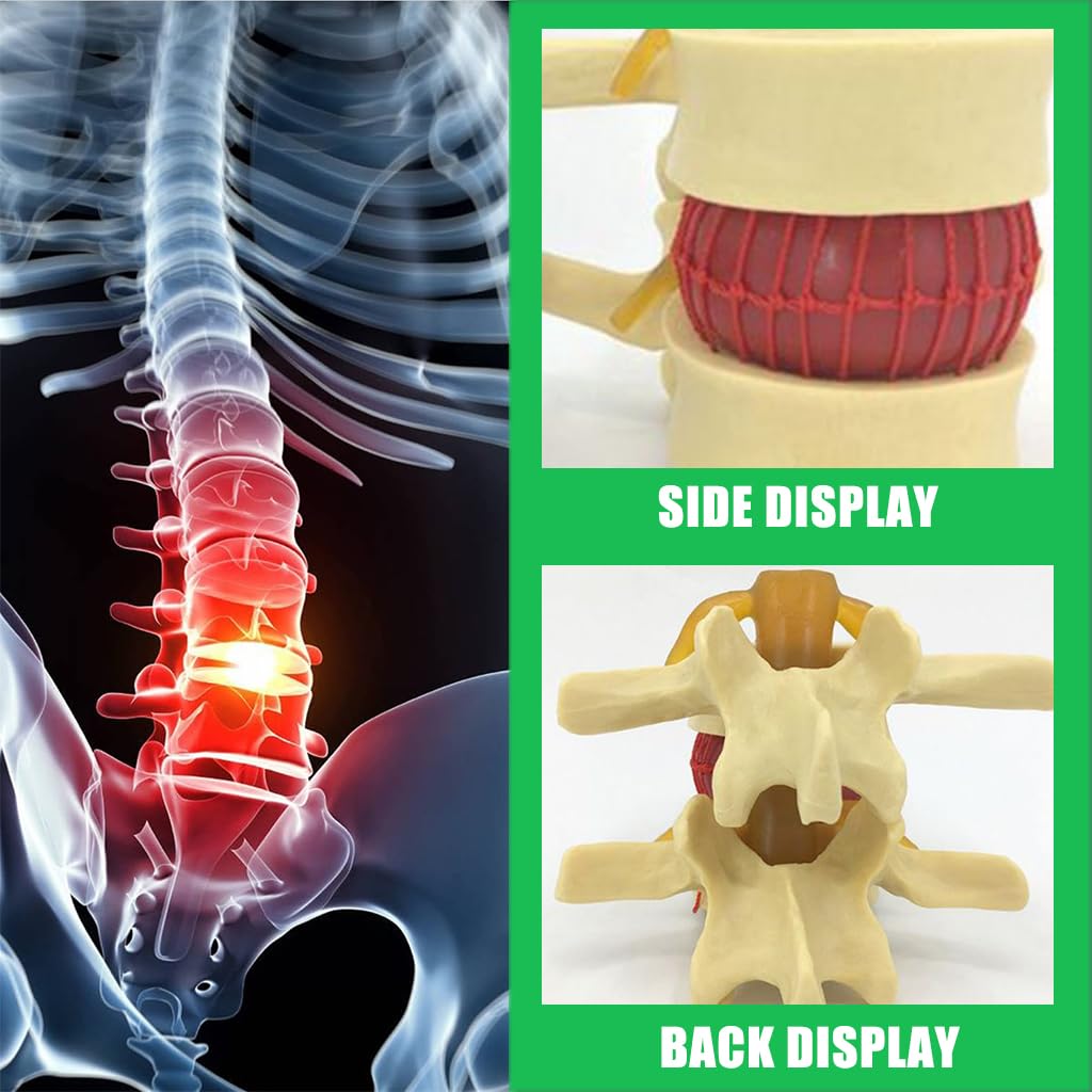 HASTHIP® Human Anatomical Lumbar Disc Herniation Model, 1.5 Times Life Size Lumbar Disc Herniation Model, Human Lumbar Disc Herniation Model for Teaching, Learning, Demonstrating (Yellow)