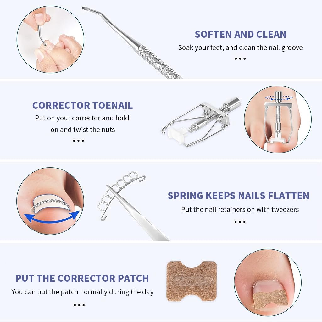 HANNEA Ingrown Toenail Treatment Kit for Home Relief with 50pcs Brace Stickers and Stainless Steel Tools