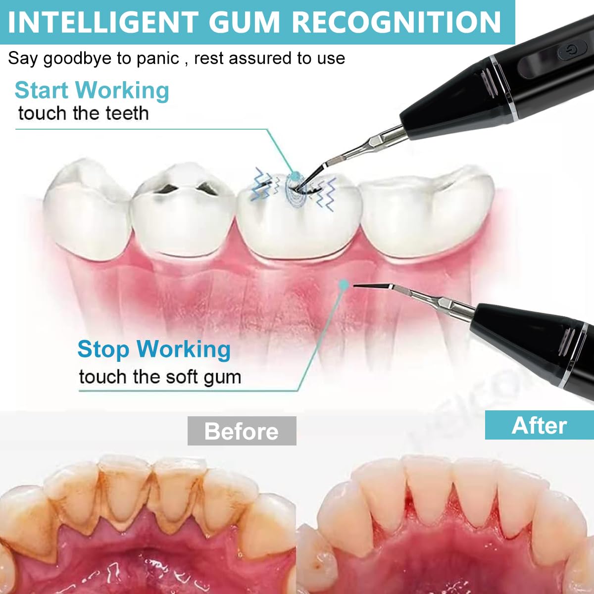 HANNEA Teeth Whitening Kit with LED and 4 Stainless Steel Bits for Deep Cleaning | USB Rechargeable