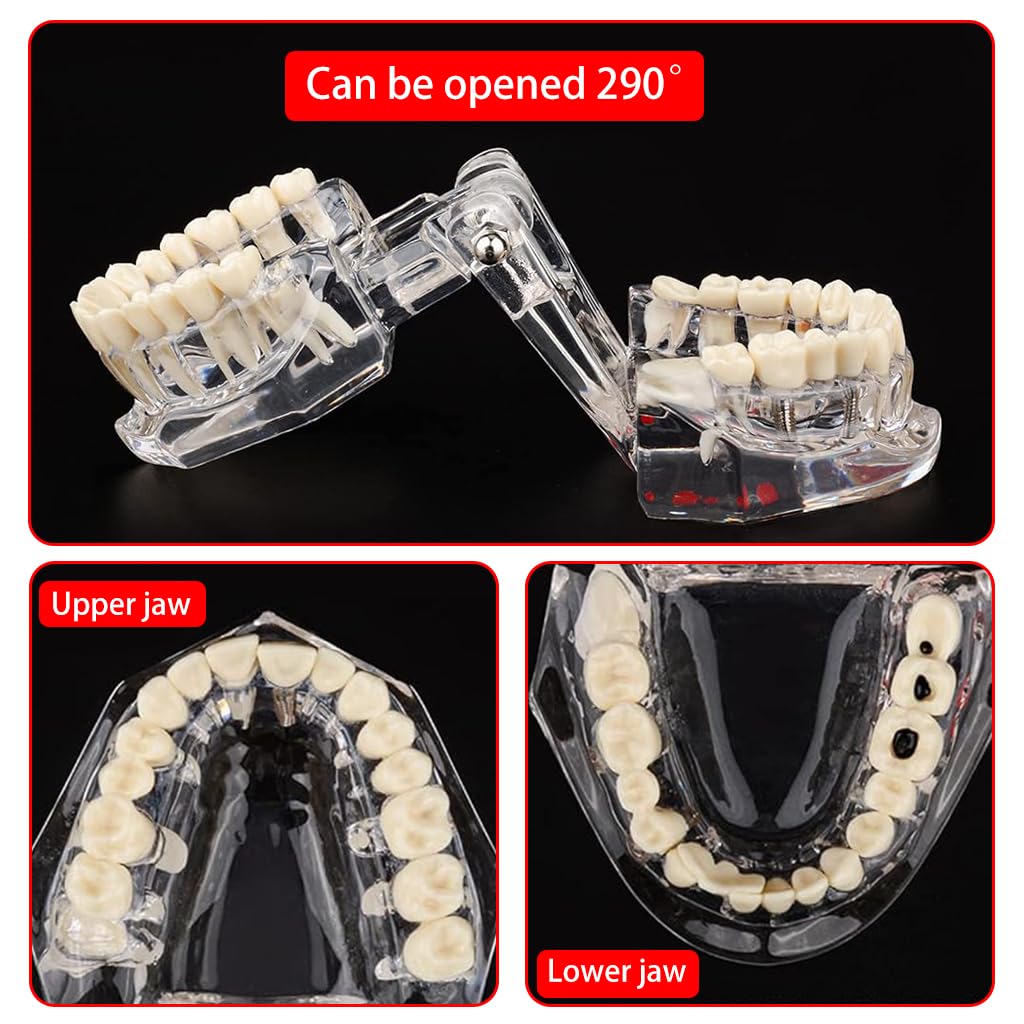 Serplex® Transparent Dental Model 1: 1 Adults Pathological Dental Model with Detachable Teeth Educational Tool for Dentists, Hygienists, Students