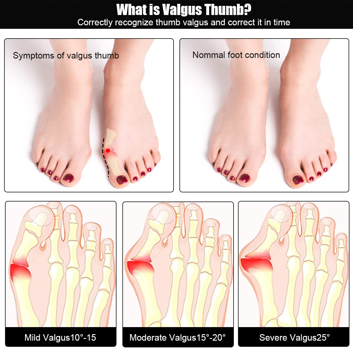 HANNEA Bunion Corrector, Hallux Valgus Splint, Bunion Splints and bunion Toe corrector, Bunion Correction Toe Separator With Support for Men and Women