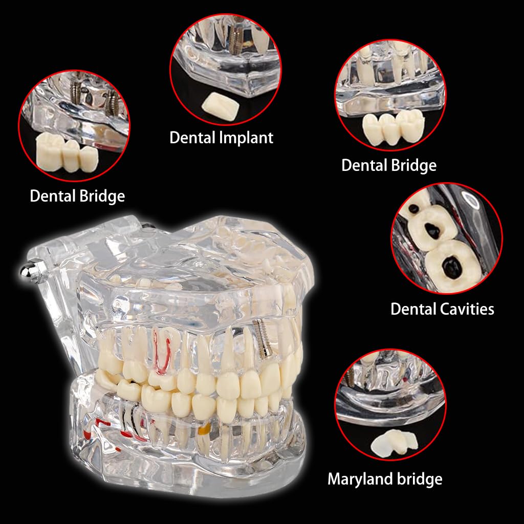 Serplex® Transparent Dental Model 1: 1 Adults Pathological Dental Model with Detachable Teeth Educational Tool for Dentists, Hygienists, Students