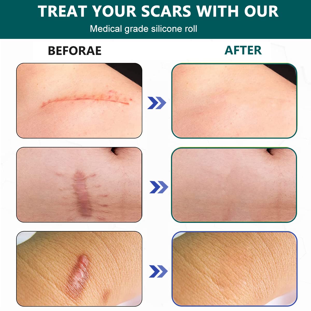 ZIBUYU Silicone Scar Tape for Surgery and C Section Scars 1.6x118 in Roll | Easy Tear Medical Grade