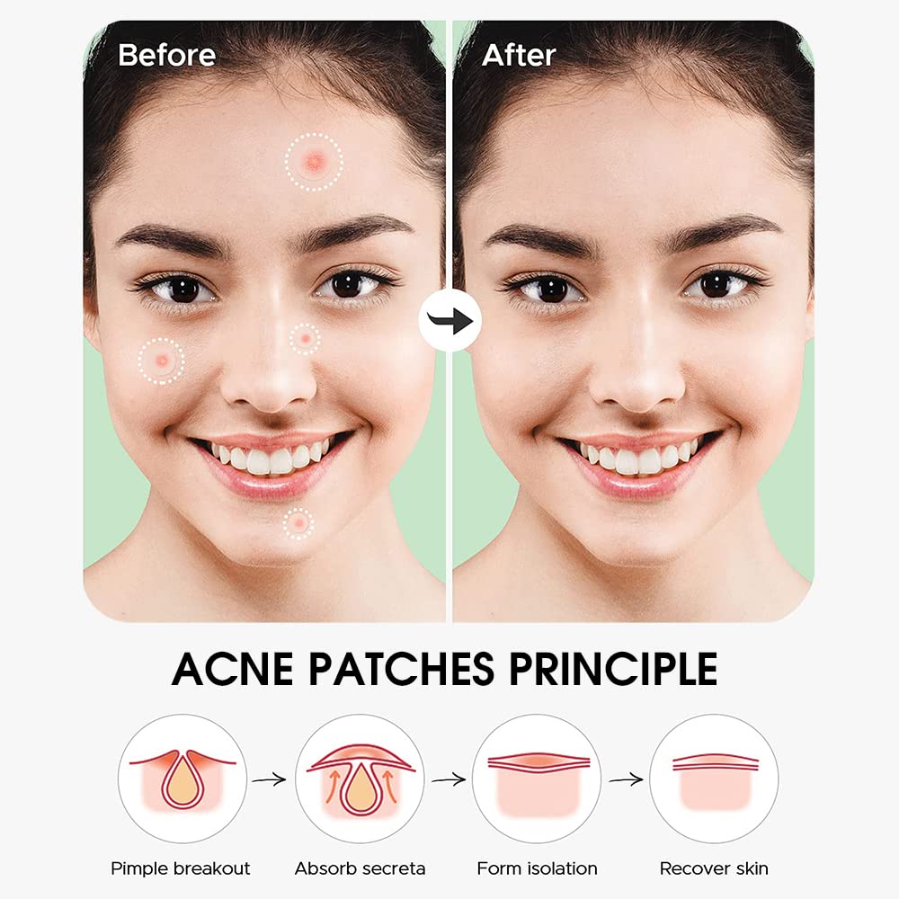 MAYCREATE 108Piece Acne Pimple Patch Invisible Hydrocolloid Acne Patch for Women Men Boy Girls-Acne Spot Healing Patches For Most Skin Types