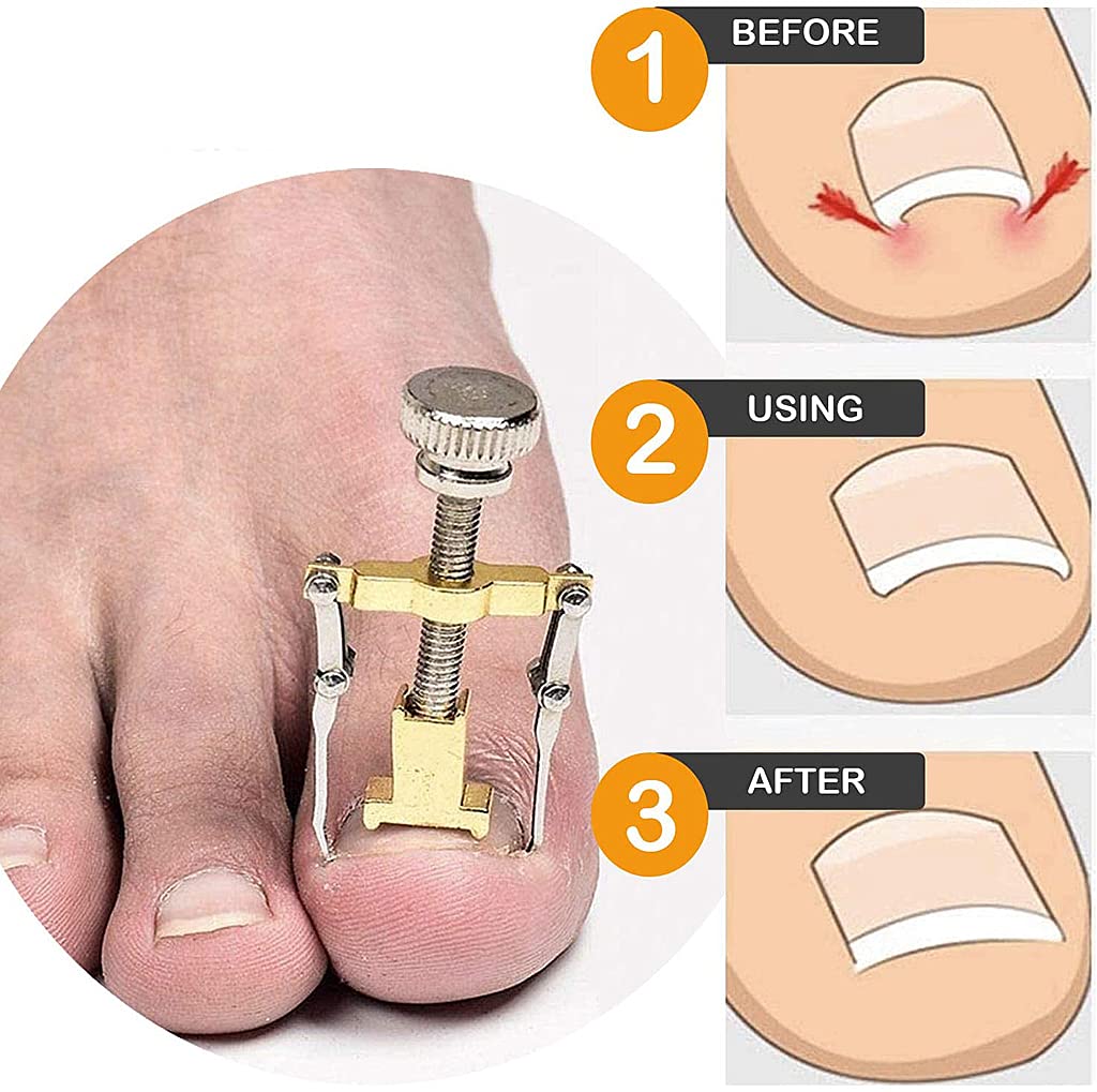 HASTHIP Nail Clippers for Ingrown and Thick Toenails with Lever Action and Stainless Steel | Professional Pedicure Tools Kit