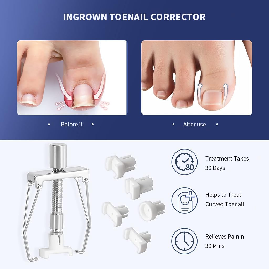 HANNEA Ingrown Toenail Treatment Kit for Home Relief with 50pcs Brace Stickers and Stainless Steel Tools