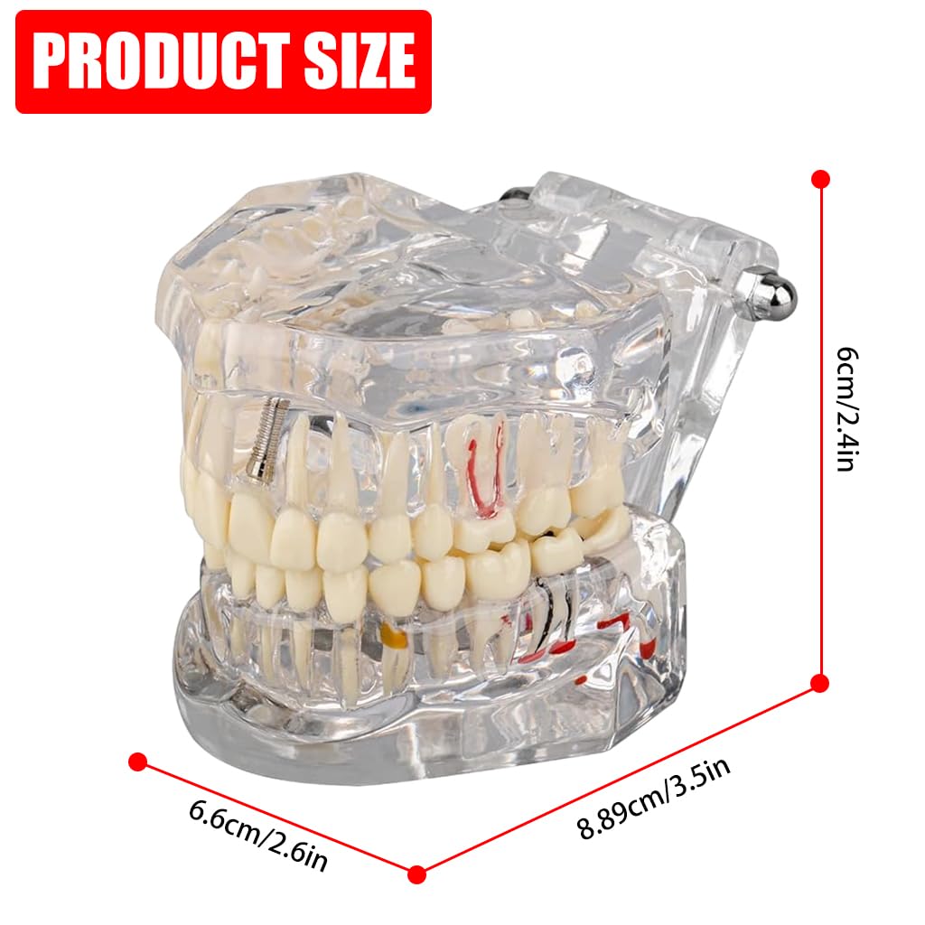 Serplex® Transparent Dental Model 1: 1 Adults Pathological Dental Model with Detachable Teeth Educational Tool for Dentists, Hygienists, Students