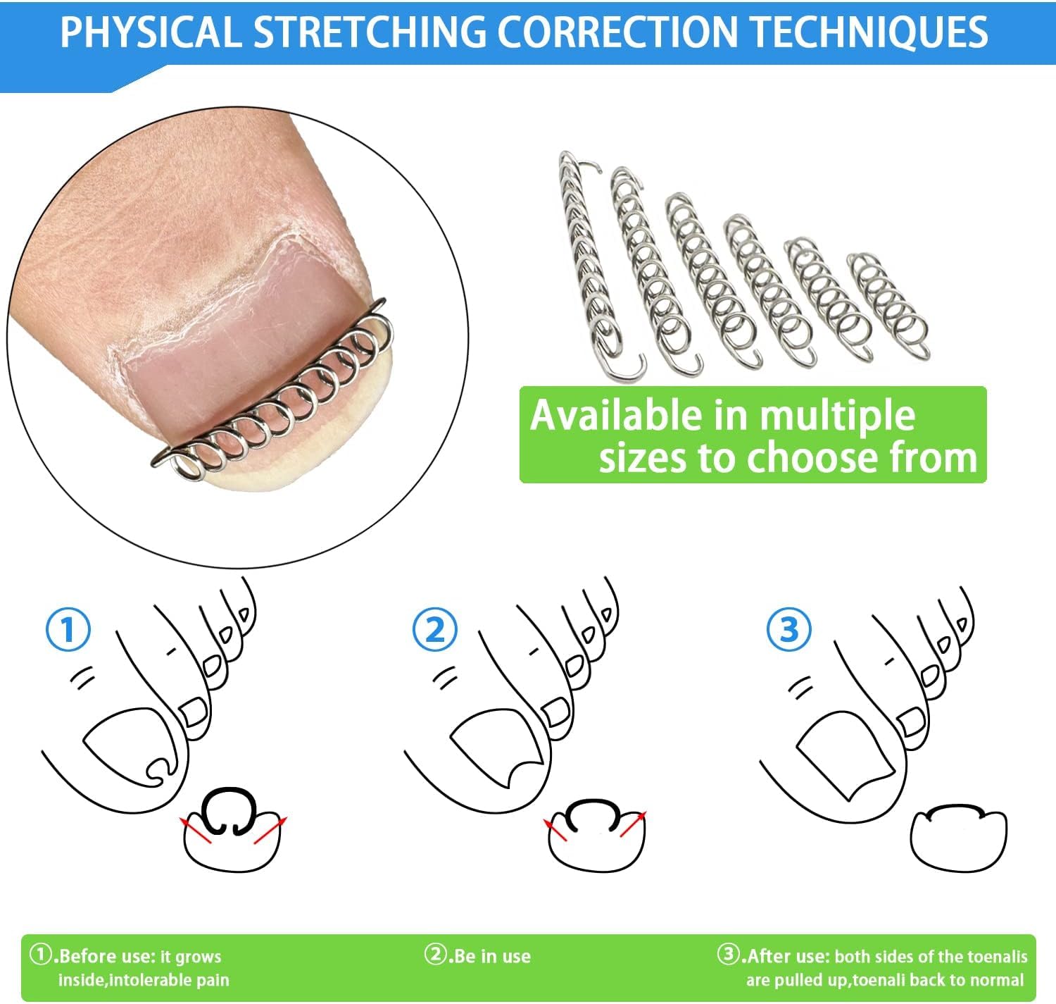 HANNEA® Ingrown Toenail Treatment Kit, Professional Ingrown Toenail Corrector Patch and Ingrown Toenail Corrector Strips, Podiatry Toenail Braces for Corrects And Relieves Toenail Pain